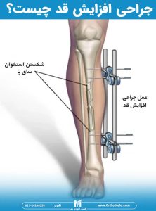 بلندتر شدن قد با عمل جراحی افزایش قد