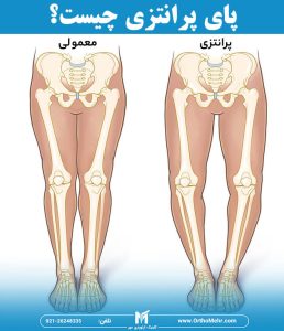 پای پرانتزی چیست