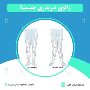 زانوی ضربدری یا ایکسی چیست