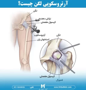 آرتروسکوپی لگن چیست