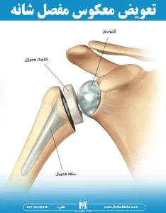 تعویض معکوس مفصل شانه