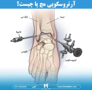 عمل آرتروسکوپی مچ پا چیست