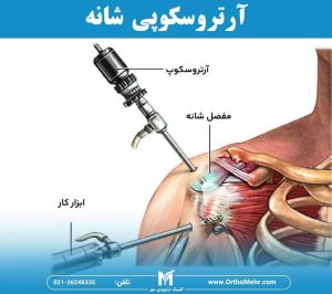 آرتروسکوپی شانه چیست